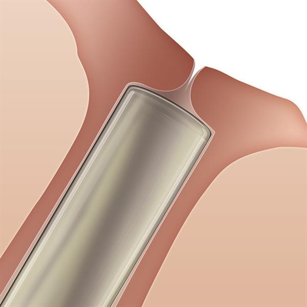 Oasis SOFT PLUG Collagen Intracanallcular Plugs (60pack) 3 Sizes